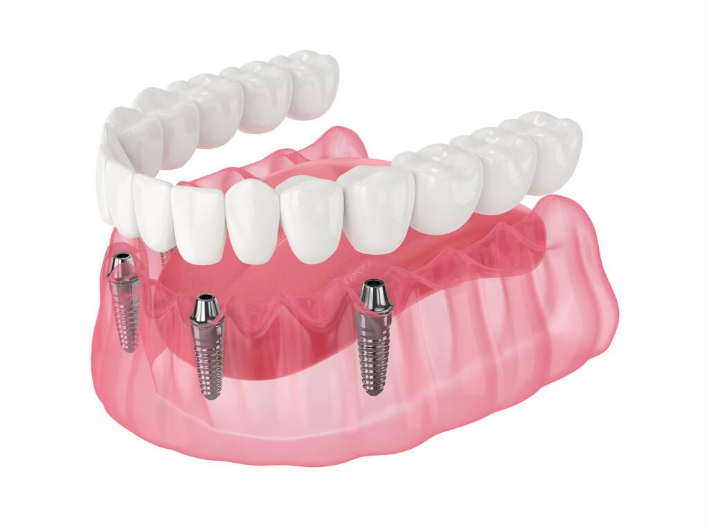 Best All on 4 implants in Melbourne