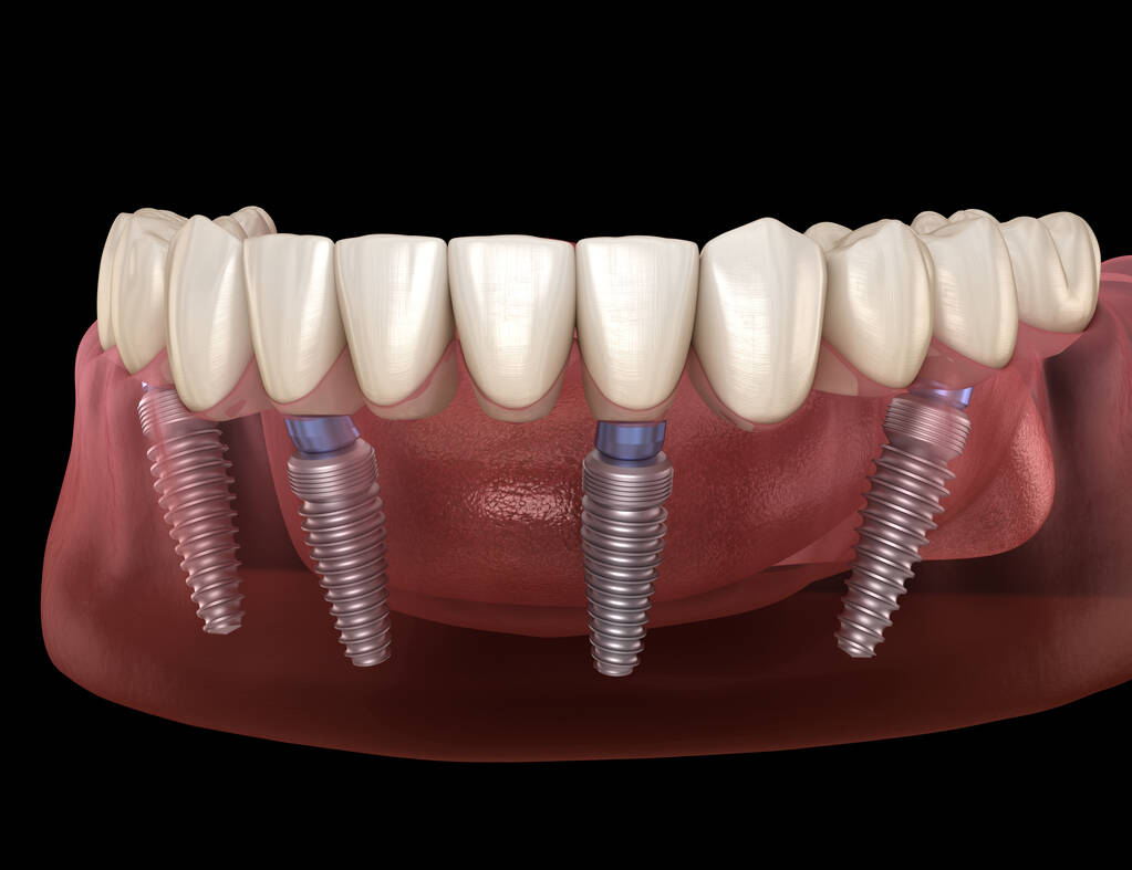 All on 4 dental implants