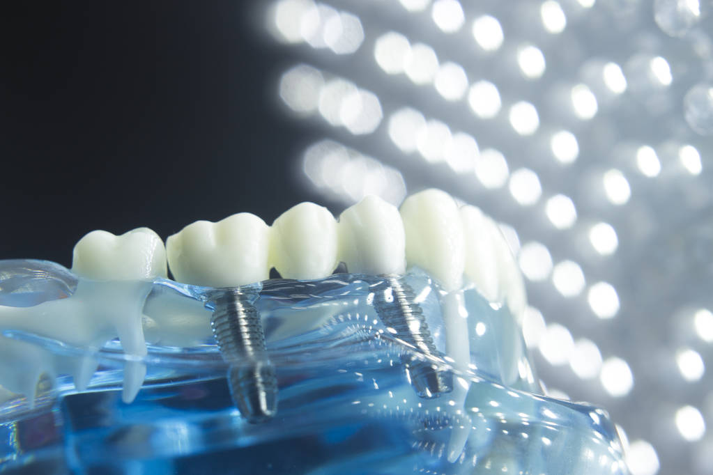 Dental implants in Brisbane