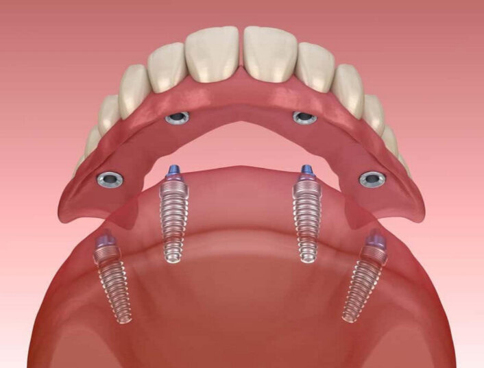 All on 4 dental implants