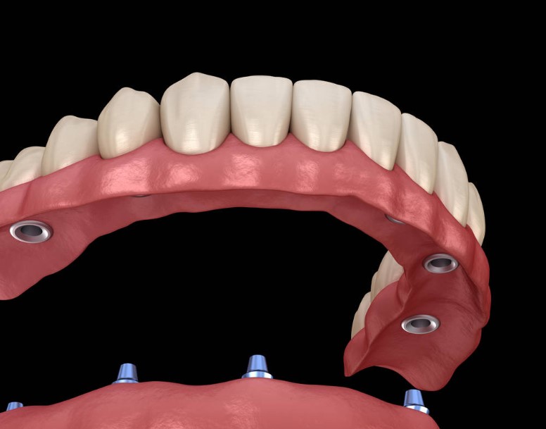 all on 4 dental implant