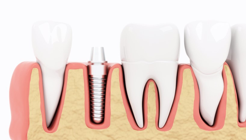 all on 4 dental implants