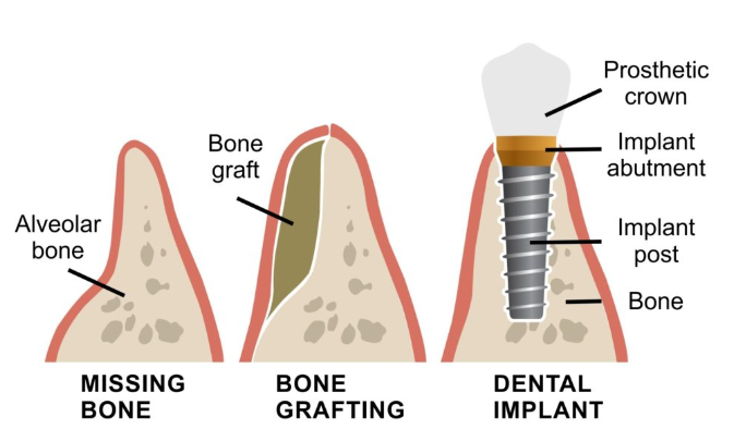 bone grafting for dental implants